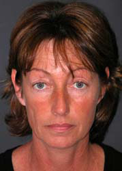 Mid Facelift - Patient 3 - Front - Before